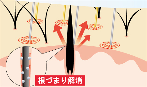 毛根をクレンジング